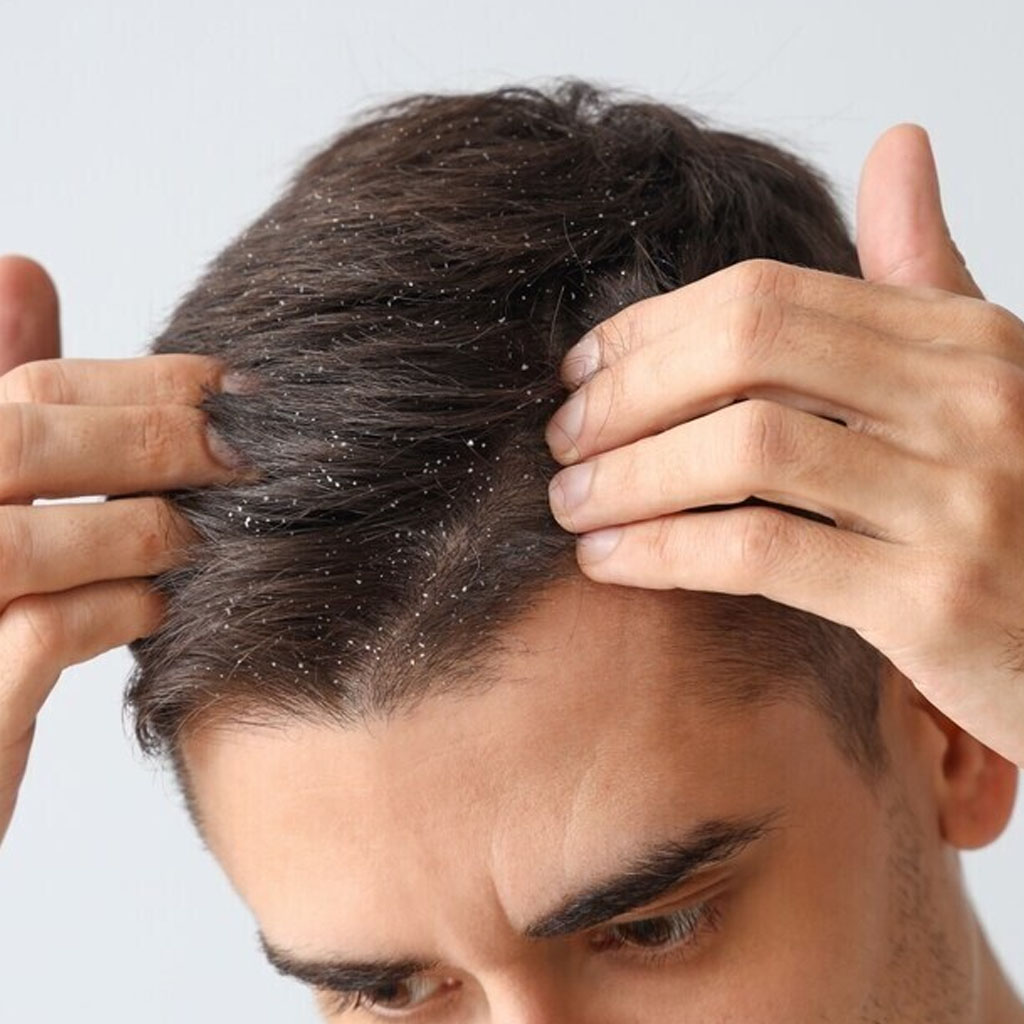 Dandruff Treatment